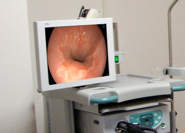 胃カメラ(鼻からの胃内視鏡)